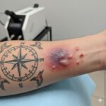 Tattoo Removal Side Effects: What’s Normal and What’s Not