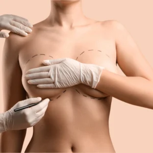 breast-augmentation-300x300