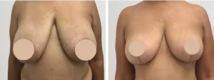 breast reduction p