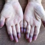 oxygen level kam hone ke lakshan