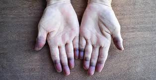 oxygen level kam hone ke lakshan