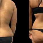 Butt Fat Trnasfer in Dubai