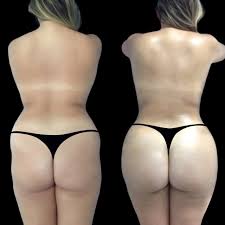 Butt Fat transfer in Dubai,