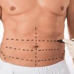 Fat Transfer in Dubai