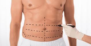 Fat Transfer in Dubai