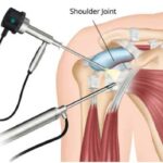 shoulder arthroscopy Bayonne NJ