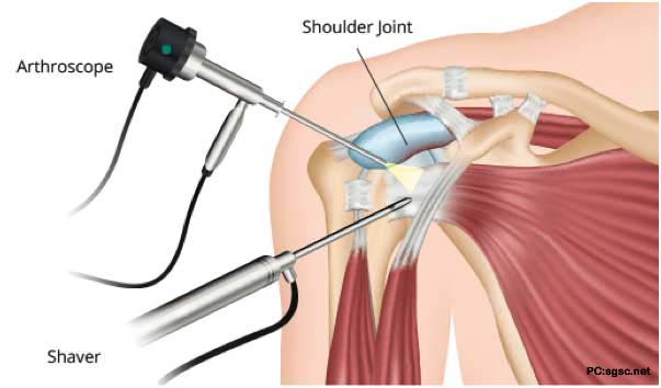 shoulder arthroscopy Bayonne NJ