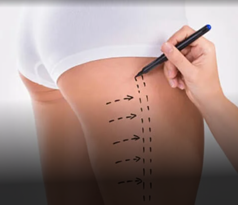Thigh Liposuction In Dubai