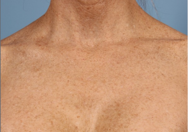 Underarm Laser Hair Removal in NYC