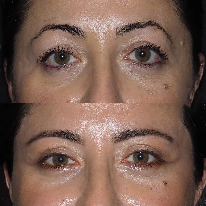 Eye bag Removal in Dubai