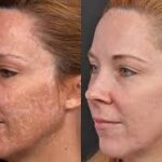 Depigmentation in Altrincham