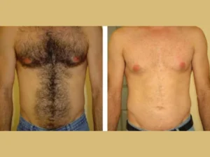 Electrolysis Laser hair removal in dubai