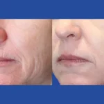 fractional rf microneedling