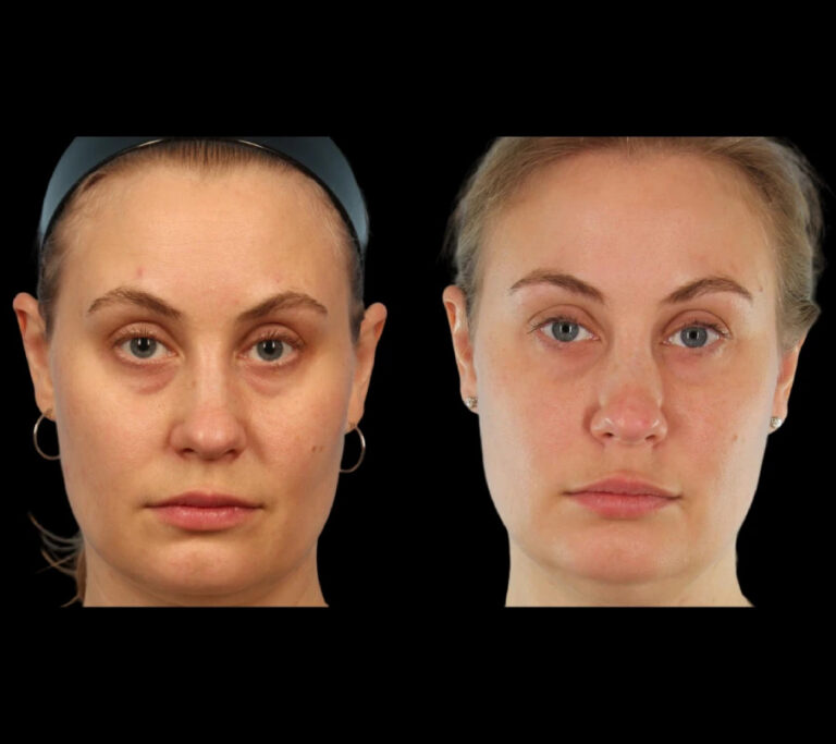 under eye fillers