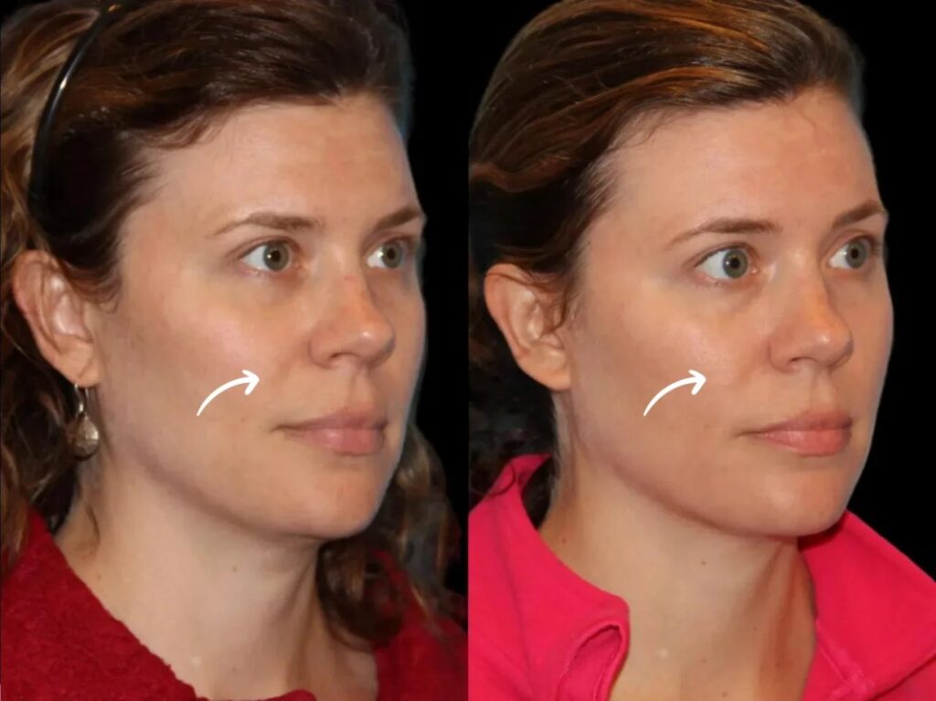 sculptra fillers in dubai