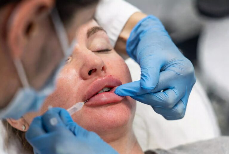 How Often Should You Get Lip Filler Touch-Ups