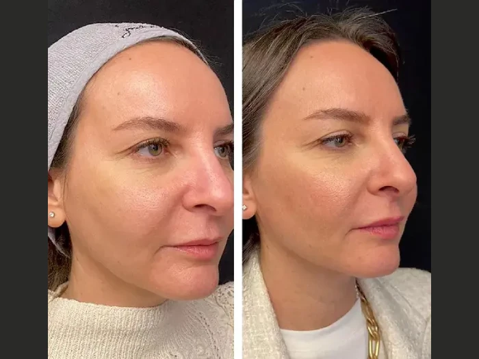 Mesotherapy Treatmen in dubai