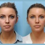 Precision Thread Lift Treatment in Dubai High Quality for Face Jawline