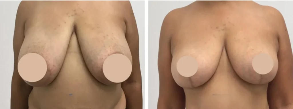 breast reduction in dubai