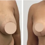 breast reduction in dubai