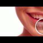 Hollywood Smile makeover in Dubai