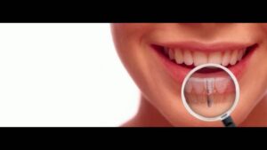 Hollywood Smile makeover in Dubai