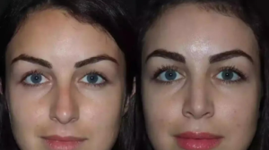rhinoplasty in dubi