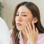 Melasma and Sun Care: Prevention and Protection