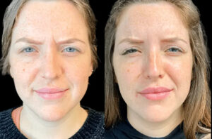 Botox for Smooth Skin by the Best Doctors in Dubai