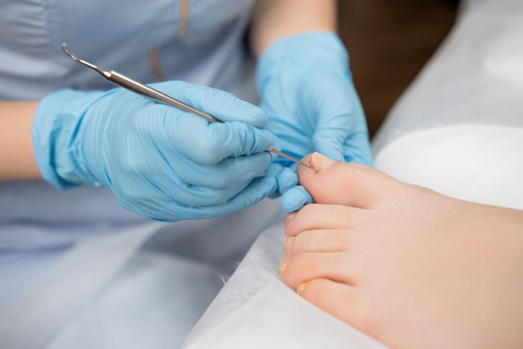 ingrown toenail treatment