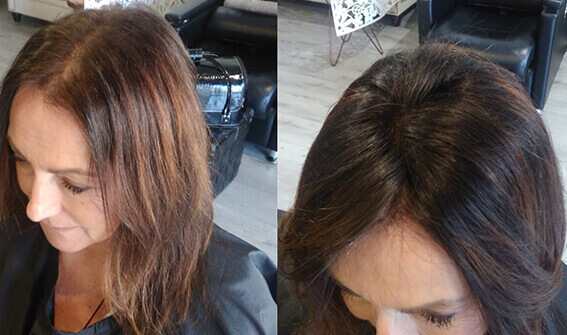 Female-Hair-Loss-system