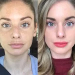 RF-Microneedling in dubai