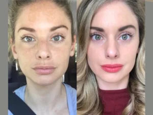 RF-Microneedling in dubai