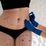 Liposuction in Dubai