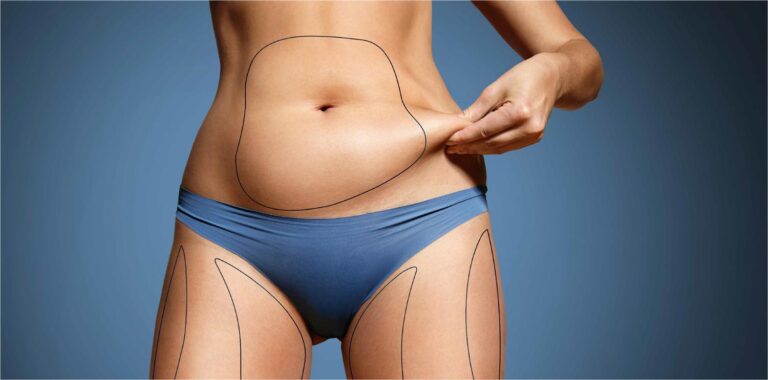 abdominoplasty dubai