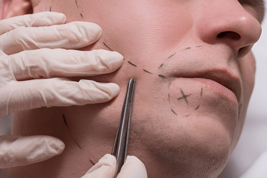 beard transplant