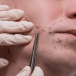 beard transplant