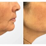 Thread lift in Dubai Combining Lifting Tightening and Collagen Renewal