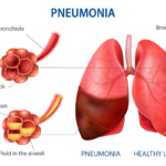 Pneumonia-1