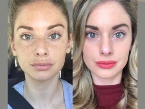 Radiofrequency (RF) Microneedling treatments in dubai