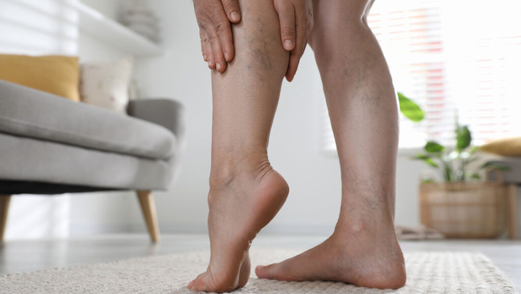 Spider Veins In Manchester