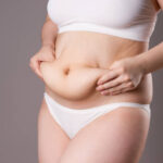 Tummy Tuck Surgery in Dubai