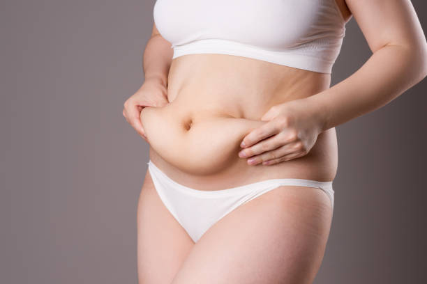 Tummy Tuck Surgery in Dubai