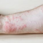 allergens that cause contact dermatitis