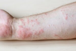 allergens that cause contact dermatitis