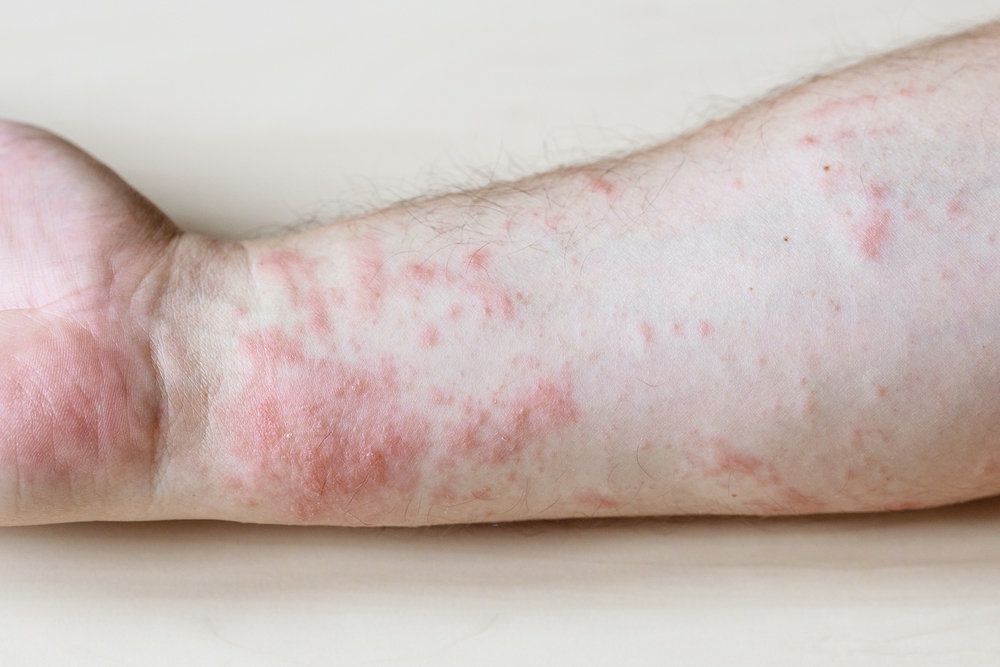 allergens that cause contact dermatitis