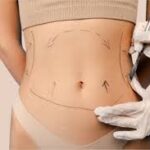 Liposuction in Dubai