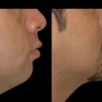 Double chin removal in Dubai