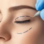 Upper Eyelid Surgery
