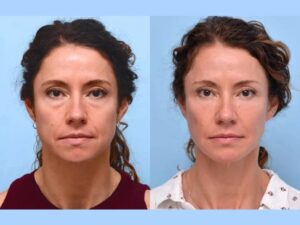 Best Aesthetic Clinic in Dubai Offering Innovative PDO Thread Lift
